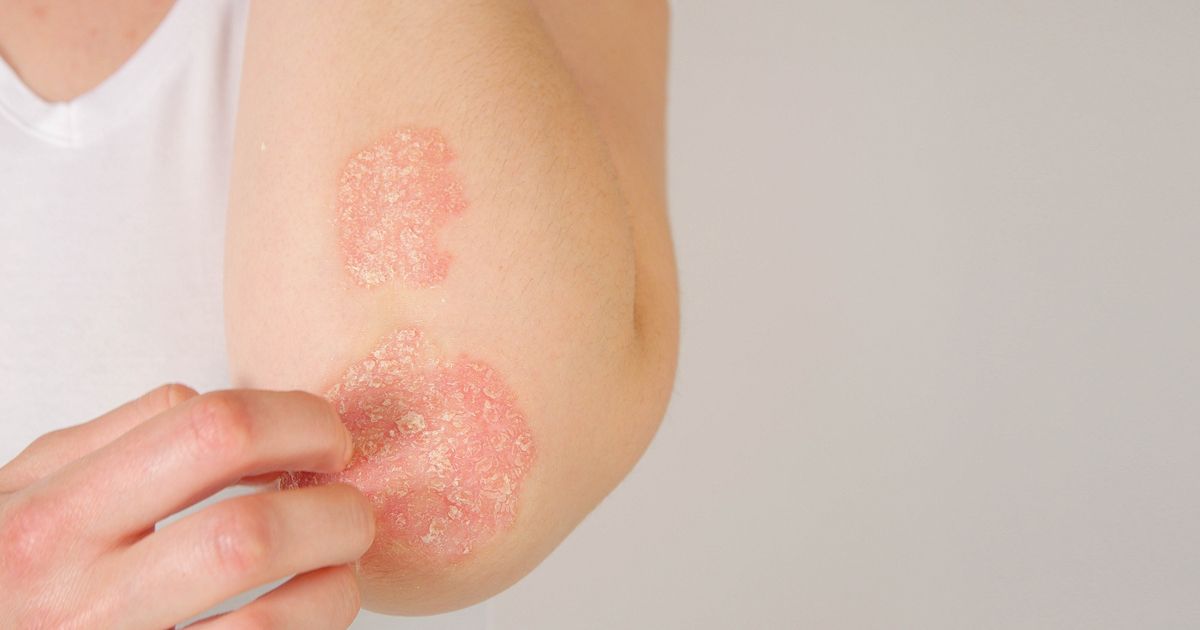 Mercola Responde: ¿Cómo controlar la psoriasis?