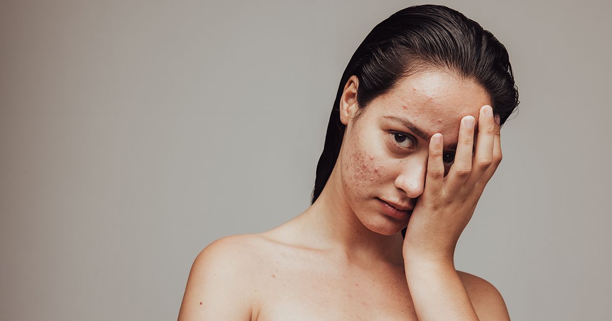 Mercola responde: ¿Cómo tratar el acné de manera natural?