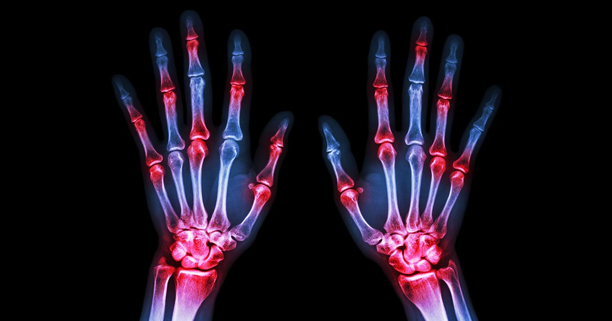 Mercola responde: ¿Cómo combatir la artritis de forma natural?