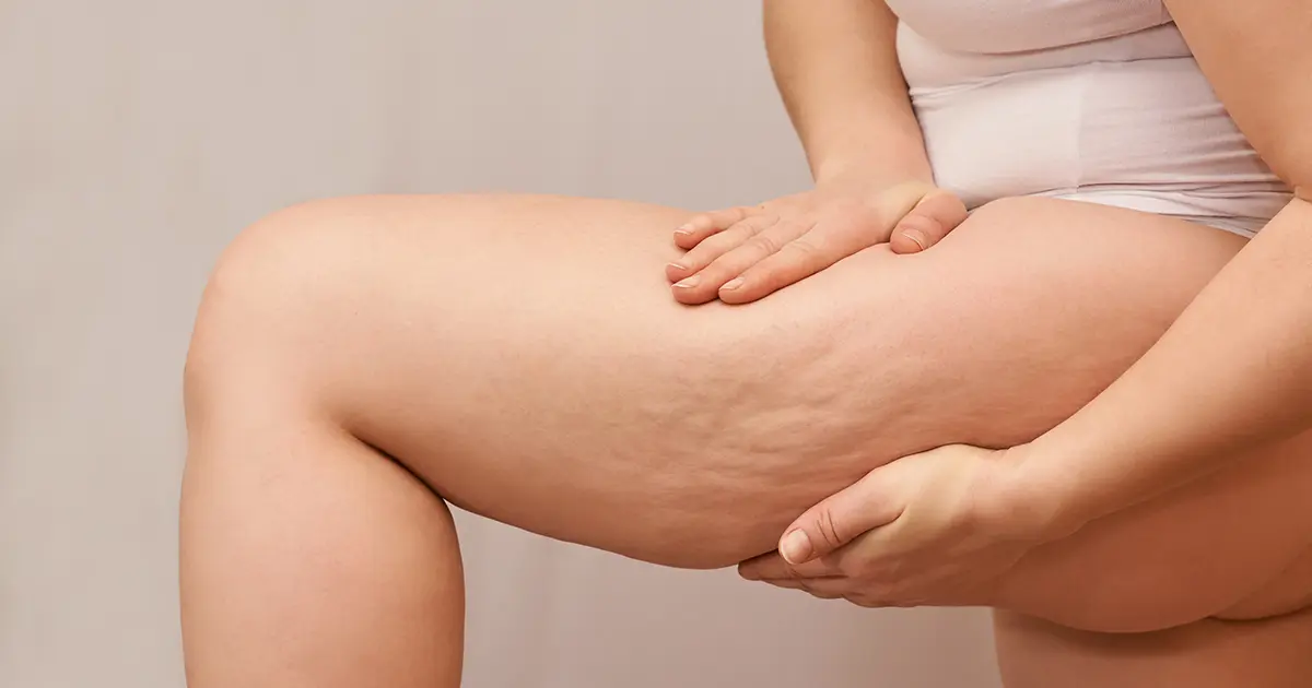 Mercola responde: ¿Cómo controlar la celulitis de manera natural?