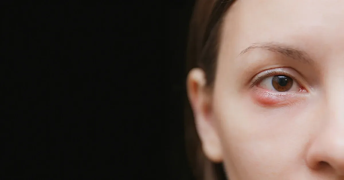 Cómo deshacerse de un orzuelo en el ojo