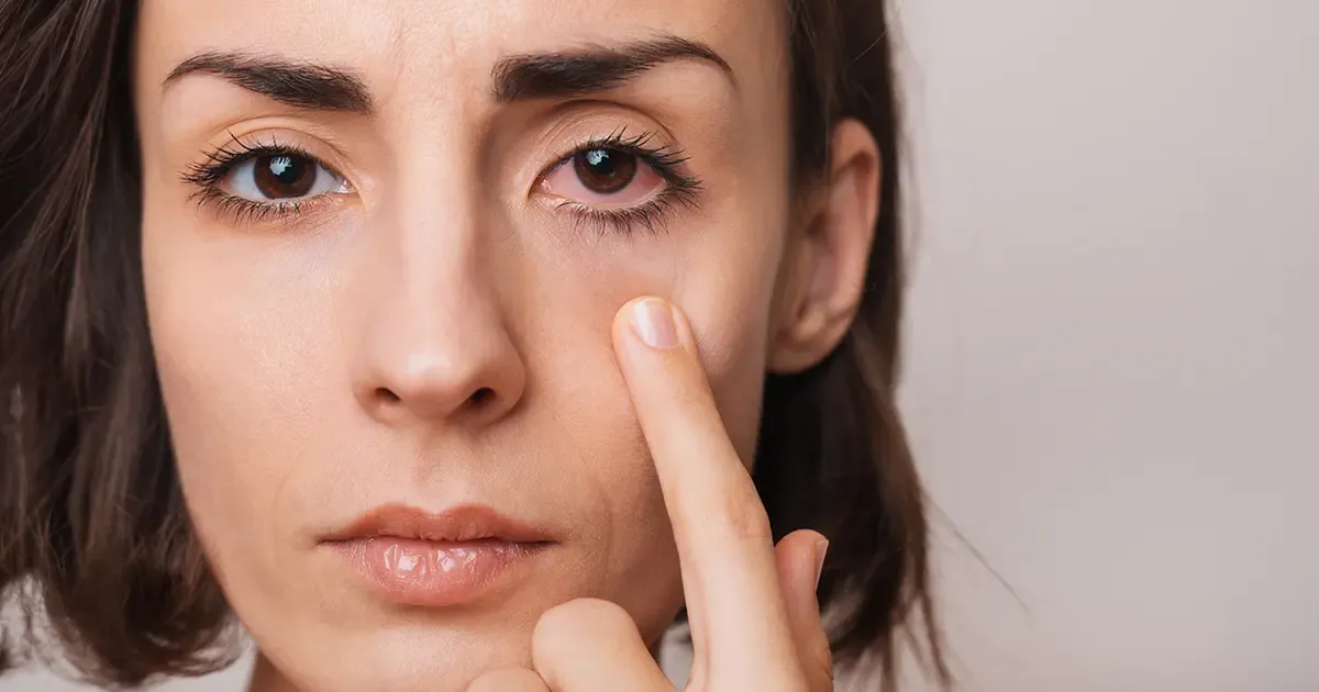 Remedios naturales para prevenir ojos secos