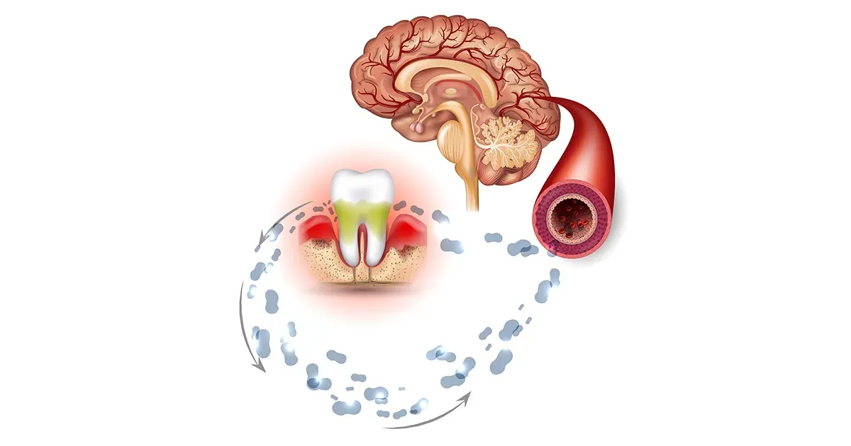 Cuide su salud bucal y evite estas bacterias que pueden dañar su cerebro