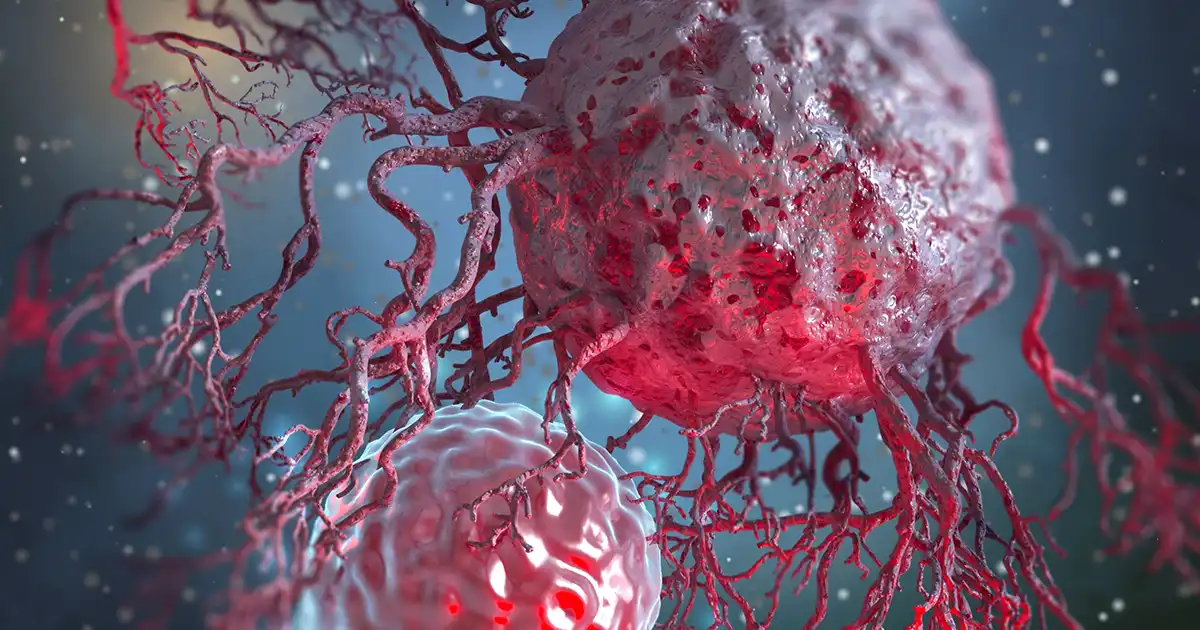 Estos son los factores que están impulsando el aumento de un cáncer peligroso