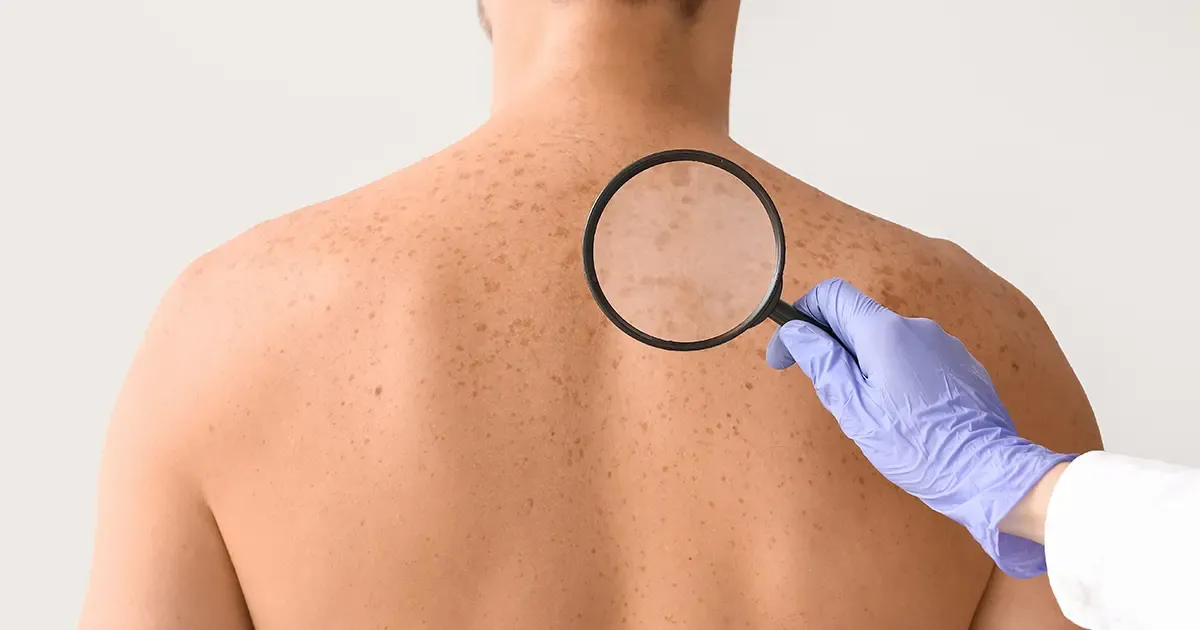 ¡Atención! Estas señales en su piel podrían estar advirtiéndole algo