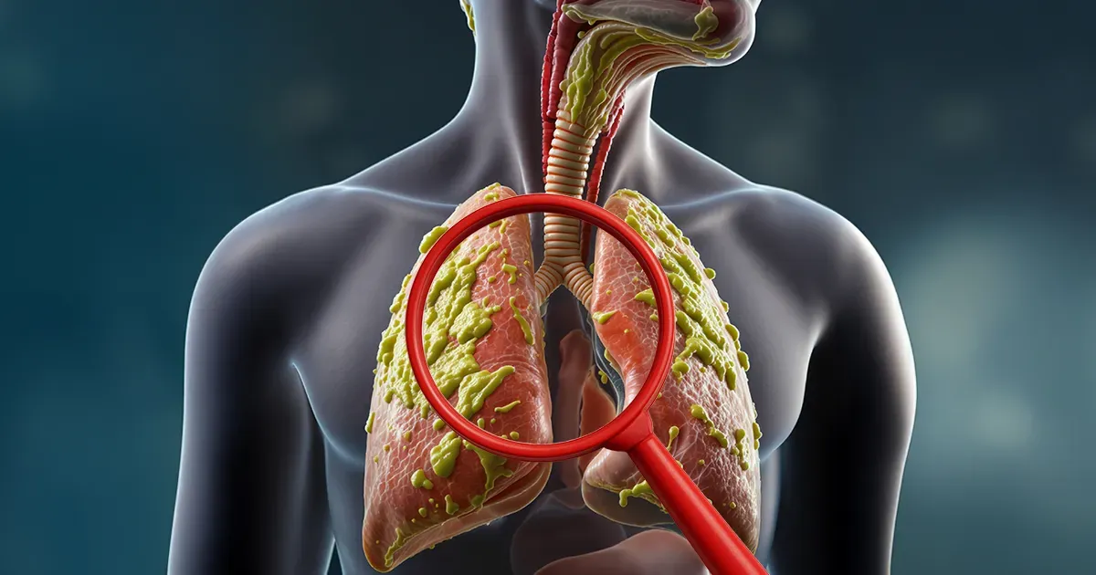 Cambios en la flema: ¿señal inofensiva o alerta respiratoria?