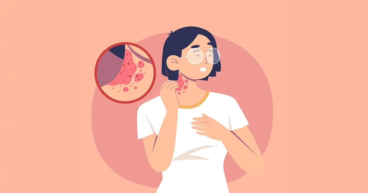 Inflamación crónica en la piel y una fuente de exposición que pocos consideran