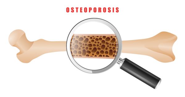 Mercola responde: ¿Cómo reducir el riesgo de osteoporosis?