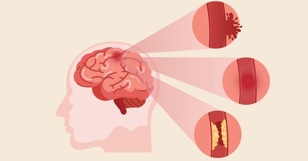 Qué hacer después de un derrame cerebral