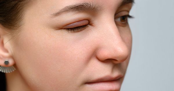 Mercola responde: ¿Pueden las alergias provocar hinchazón en los ojos por la mañana?