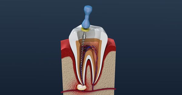 Cuidado con este procedimiento dental: asegúrese de conocer primero sus riesgos