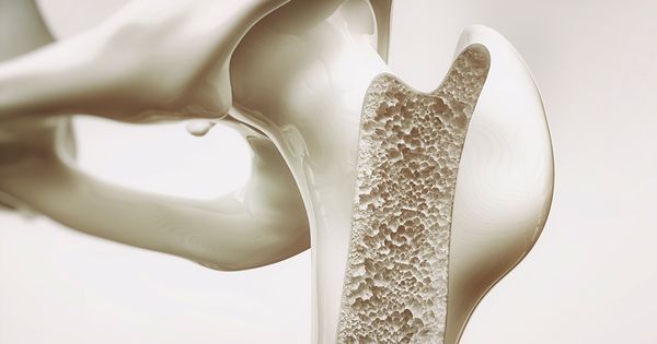 La mayoría de las personas no saben de esto hasta que sufren una fractura