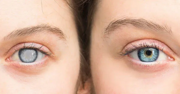 Estrategias para reducir el riesgo de esta enfermedad de los ojos