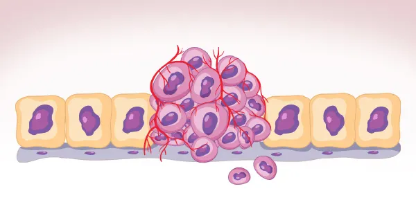 ¿Qué está causando la avalancha de carcinomas 'turbo'?