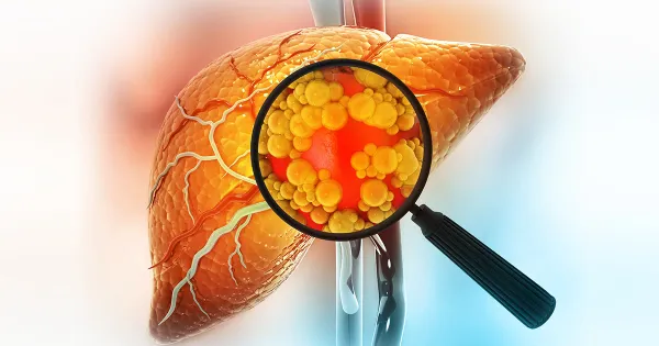 La temible enfermedad hepática que podría acabar con su vida