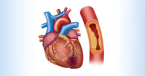 Las vitaminas que reducen el riesgo de enfermedad de las arterias coronarias