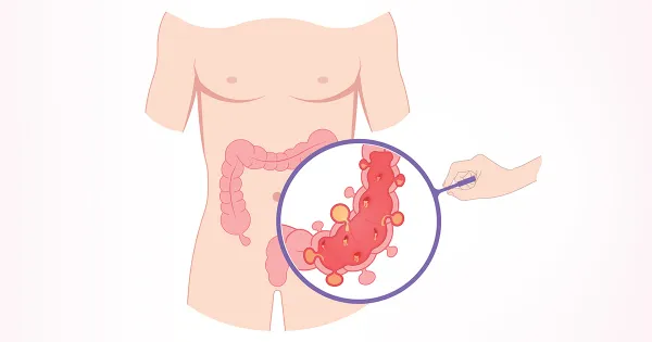 La enfermedad intestinal que puede causar graves complicaciones de salud